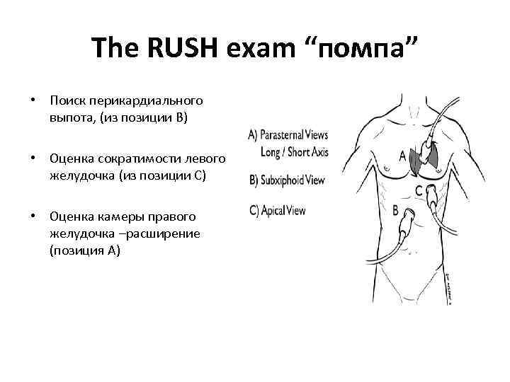 The RUSH exam “помпа” • Поиск перикардиального выпота, (из позиции В) • Оценка сократимости