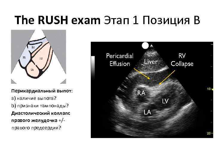 The RUSH exam Этап 1 Позиция В Перикардиальный выпот: a) наличие выпота? b) признаки