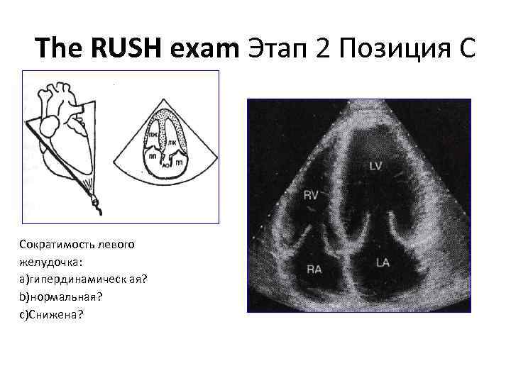 The RUSH exam Этап 2 Позиция С Сократимость левого желудочка: a)гипердинамическ ая? b)нормальная? c)Снижена?