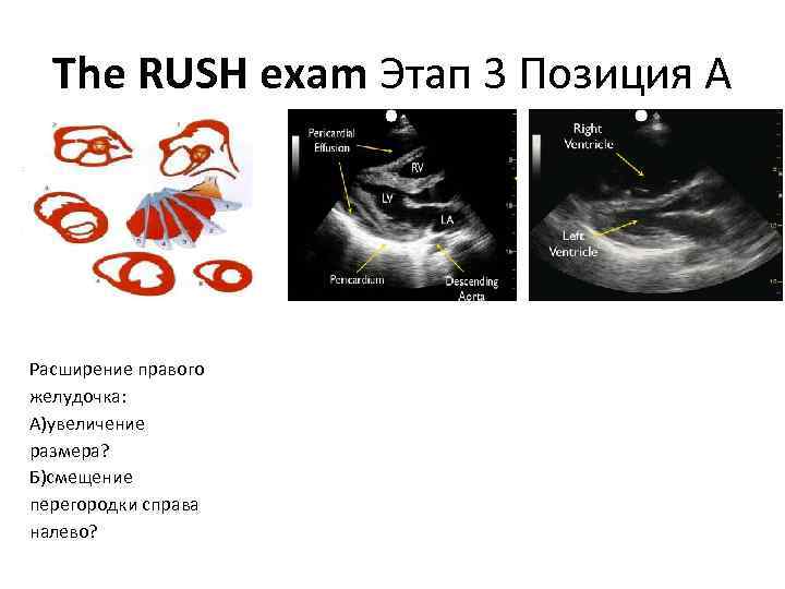 The RUSH exam Этап 3 Позиция А Расширение правого желудочка: А)увеличение размера? Б)смещение перегородки
