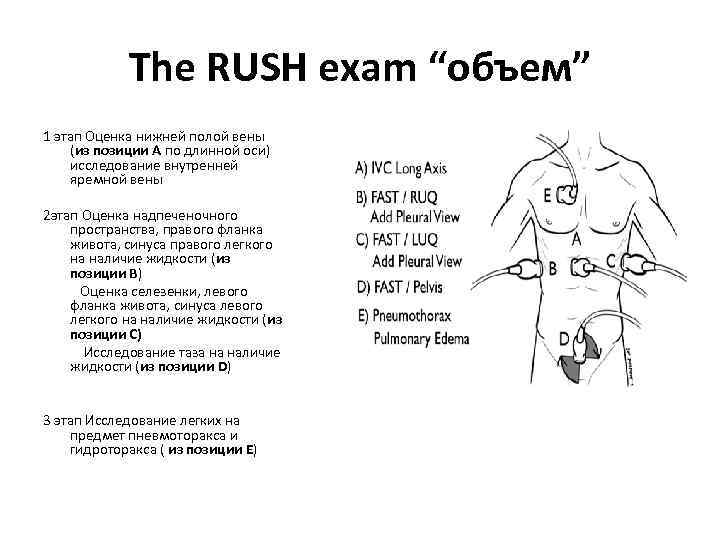 The RUSH exam “объем” 1 этап Оценка нижней полой вены (из позиции А по
