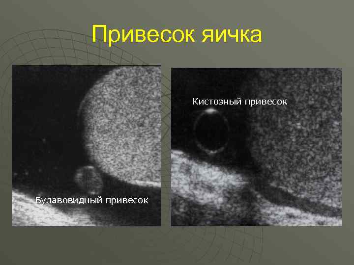 Привесок яичка Кистозный привесок Булавовидный привесок 