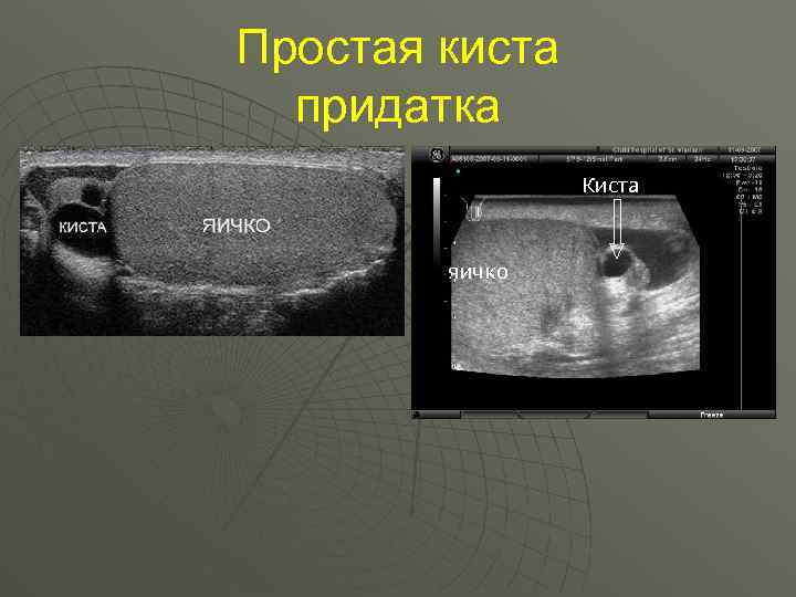 Простая киста придатка Киста яичко 