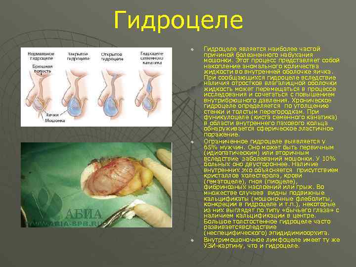 Гидроцеле u u u Гидроцеле является наиболее частой причиной болезненного набухания мошонки. Этот процесс