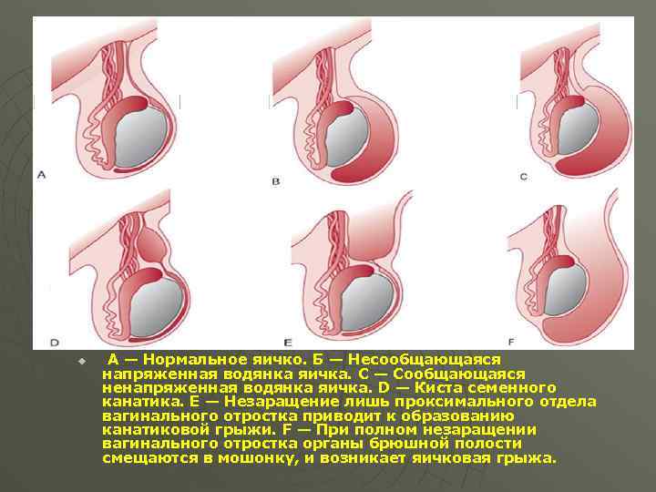 Ультразвуковая норма u А — Нормальное яичко. Б — Несообщающаяся напряженная водянка яичка. С