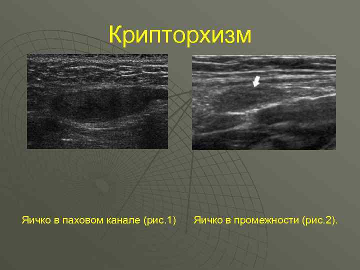 Крипторхизм Яичко в паховом канале (рис. 1) Яичко в промежности (рис. 2). 