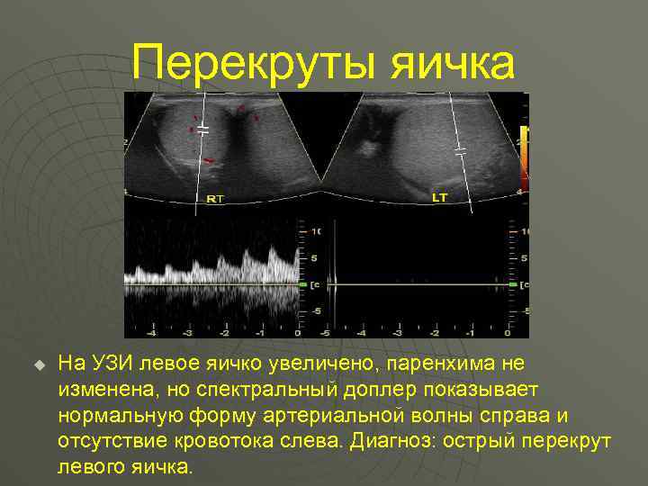 Перекруты яичка u На УЗИ левое яичко увеличено, паренхима не изменена, но спектральный доплер