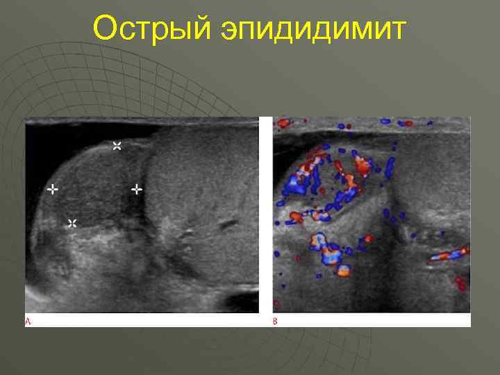 Острый эпидидимит 