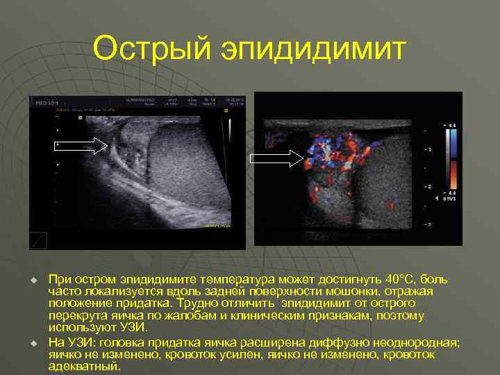 Острый эпидидимит u u При остром эпидидимите температура может достигнуть 40°С, боль часто локализуется