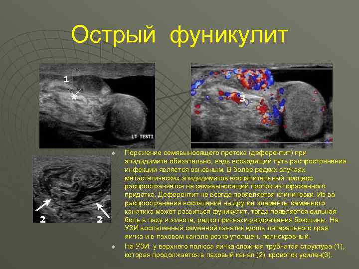 Острый фуникулит 1 3 u 2 2 u Поражение семявыносящего протока (деферентит) при эпидидимите