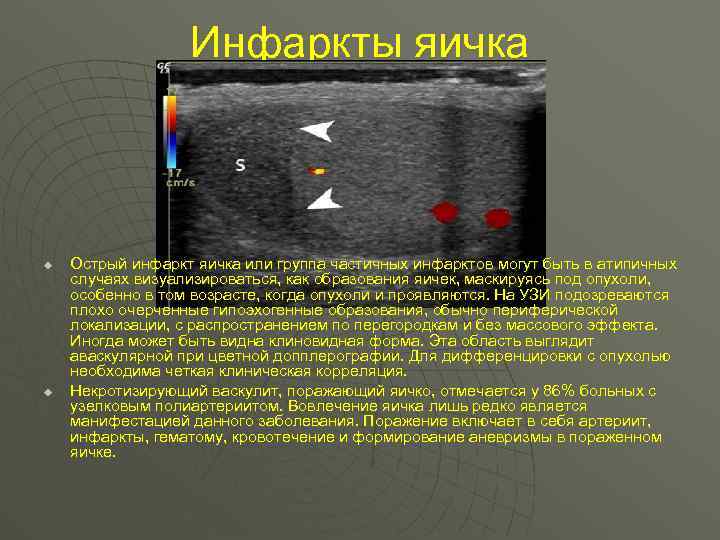 Инфаркты яичка u u Острый инфаркт яичка или группа частичных инфарктов могут быть в