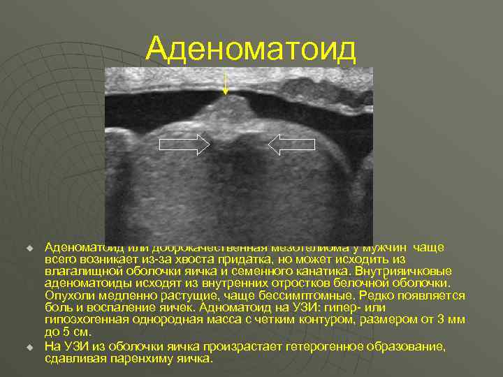 Аденоматоид u u Аденоматоид или доброкачественная мезотелиома у мужчин чаще всего возникает из-за хвоста