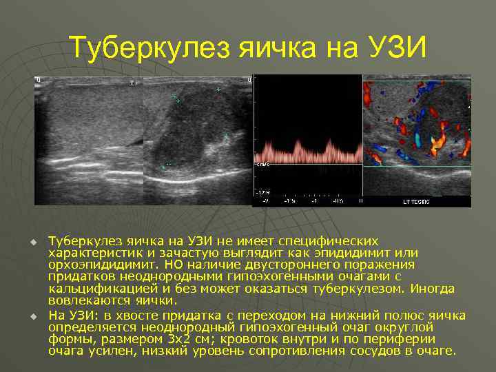 Туберкулез яичка на УЗИ u u Туберкулез яичка на УЗИ не имеет специфических характеристик