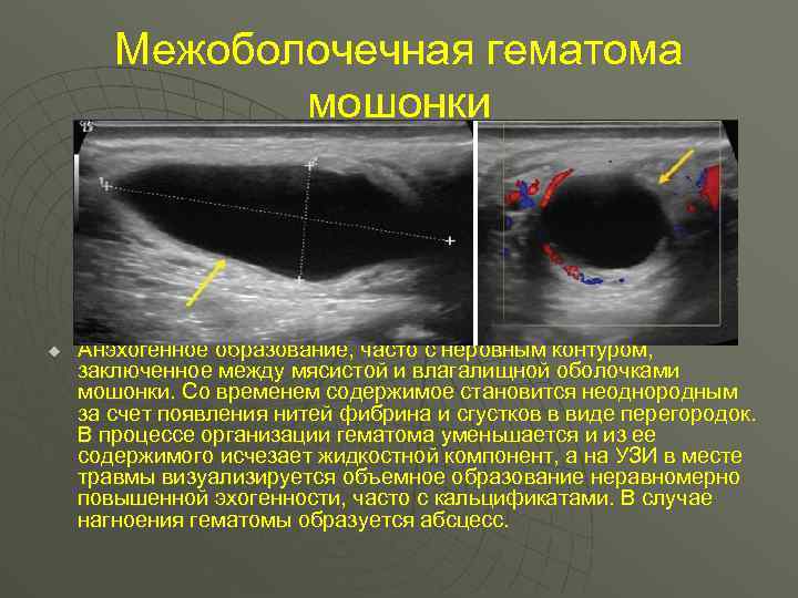 Межоболочечная гематома мошонки u Анэхогенное образование, часто с неровным контуром, заключенное между мясистой и