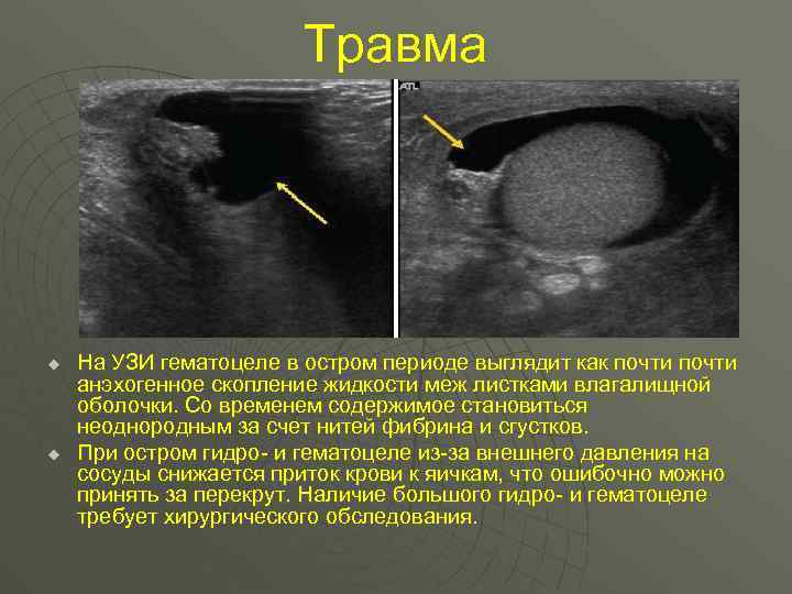 Травма u u На УЗИ гематоцеле в остром периоде выглядит как почти анэхогенное скопление