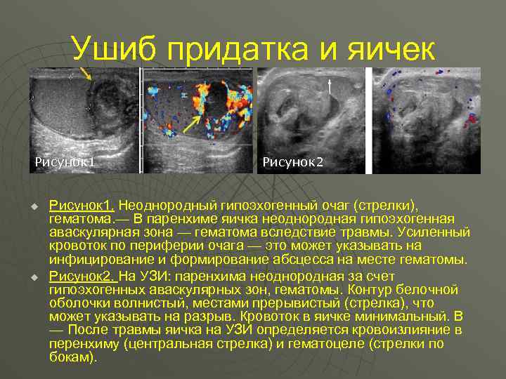 Ушиб придатка и яичек Рисунок 1 u u Рисунок 2 Рисунок 1. Неоднородный гипоэхогенный