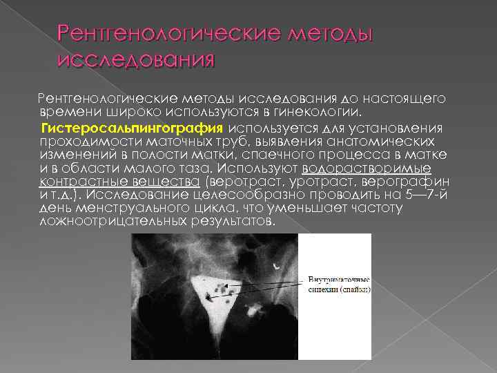 Рентгенологические методы исследования до настоящего времени широко используются в гинекологии. Гистеросальпингография используется для установления
