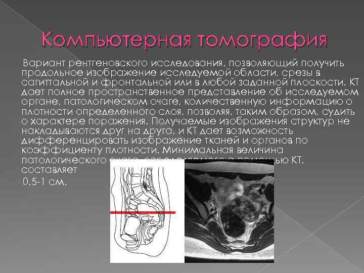 Компьютерная томография Вариант рентгеновского исследования, позволяющий получить продольное изображение исследуемой области, срезы в сагиттальной