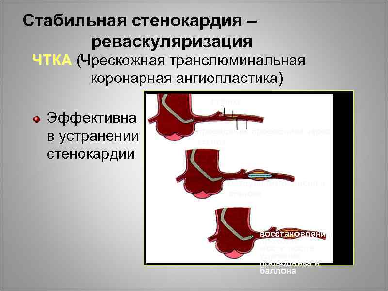 Стабильная стенокардия – реваскуляризация ЧТКА (Чрескожная транслюминальная коронарная ангиопластика) стеноз Эффективна в устранении стенокардии