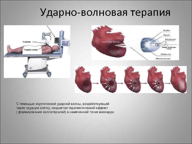 Ударно-волновая терапия С помощью акустической ударной волны, воздействующей через грудную клетку, создается терапевтический эффект