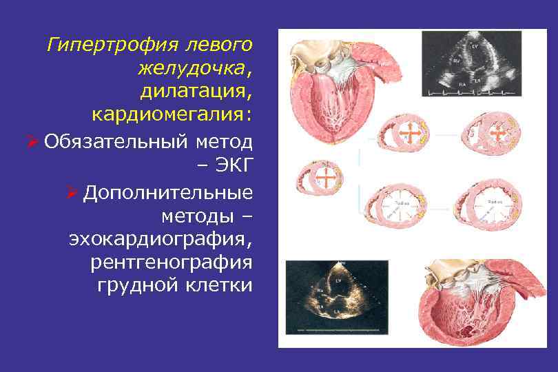 Гипертрофия левого желудочка, дилатация, кардиомегалия: Ø Обязательный метод – ЭКГ Ø Дополнительные методы –