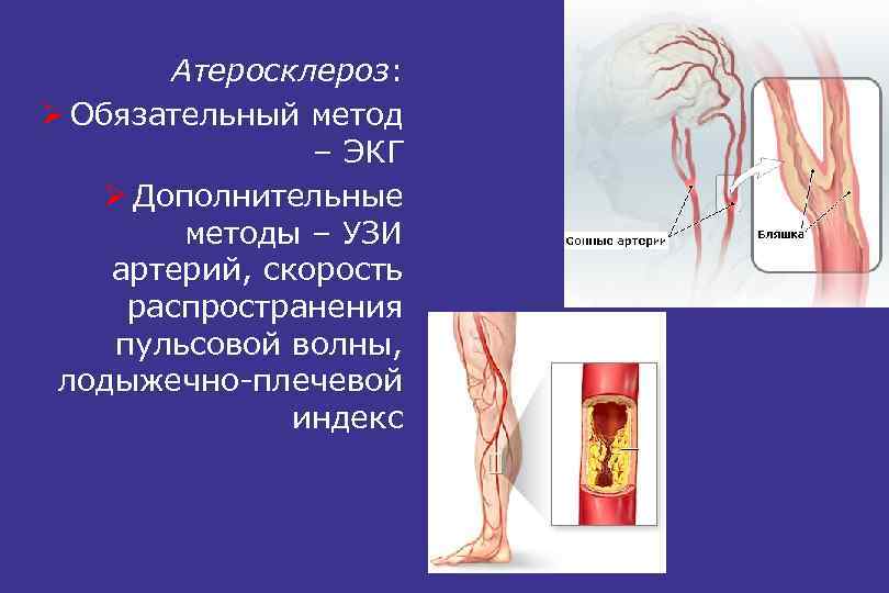 Атеросклероз: Ø Обязательный метод – ЭКГ Ø Дополнительные методы – УЗИ артерий, скорость распространения