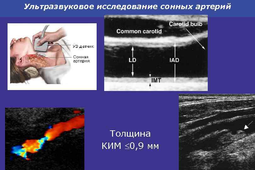 Ультразвуковое исследование сонных артерий Толщина КИМ 0, 9 мм 