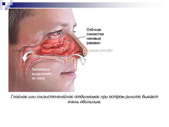 Гнойное или слизисто-гнойное отделяемое при остром рините бывает очень обильным. 