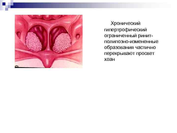  Хронический гипертрофический ограниченный ринит- полипозно-измененные образования частично перекрывают просвет хоан 