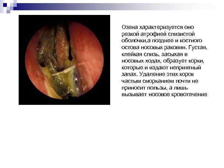 Озена характеризуется оно резкой атрофией слизистой оболочки, а позднее и костного остова носовых раковин.