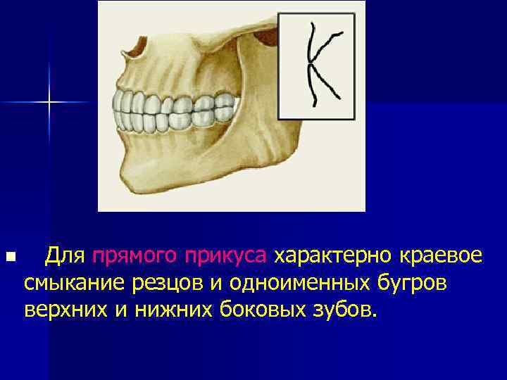n Для прямого прикуса характерно краевое смыкание резцов и одноименных бугров верхних и нижних