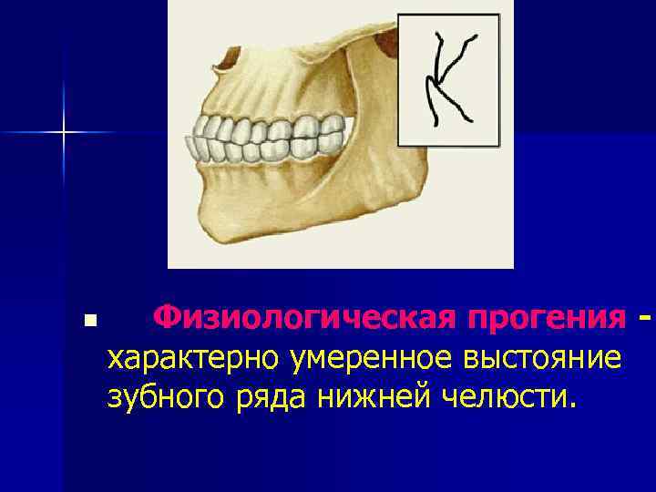 n Физиологическая прогения - характерно умеренное выстояние зубного ряда нижней челюсти. 