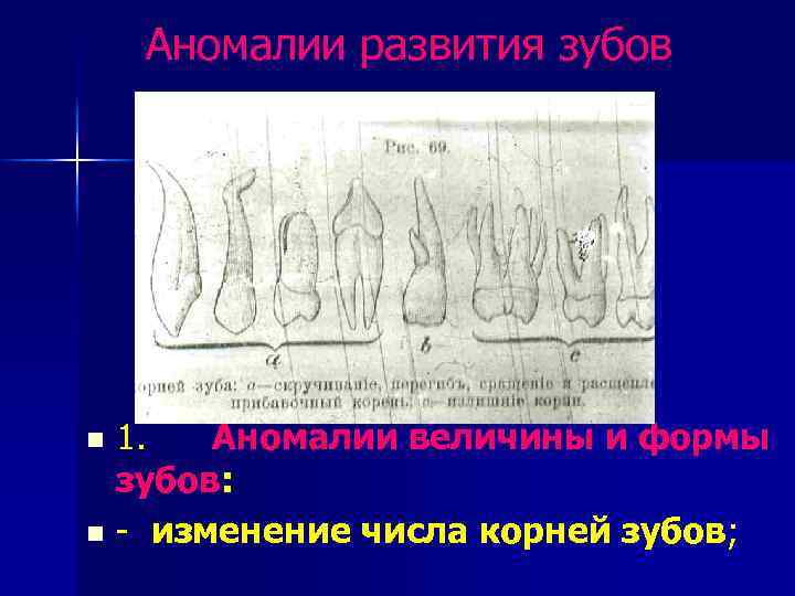  Аномалии развития зубов 1. Аномалии величины и формы зубов: n - изменение числа