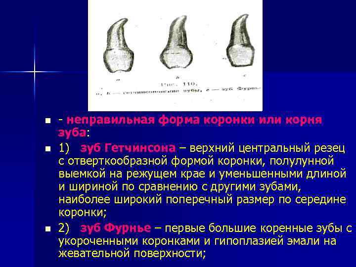 n n n - неправильная форма коронки или корня зуба: 1) зуб Гетчинсона –