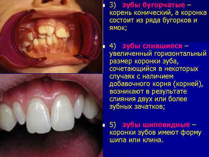n 3) зубы бугорчатые – корень конический, а коронка состоит из ряда бугорков и