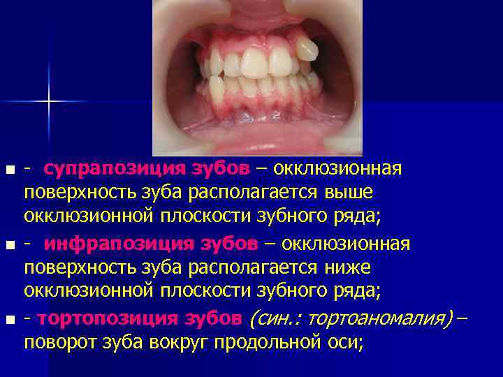 n n n - супрапозиция зубов – окклюзионная поверхность зуба располагается выше окклюзионной плоскости