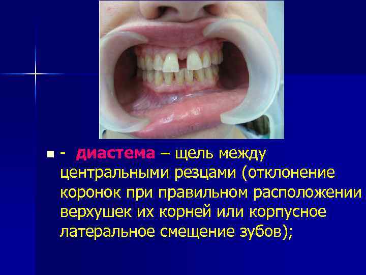 n - диастема – щель между центральными резцами (отклонение коронок при правильном расположении верхушек