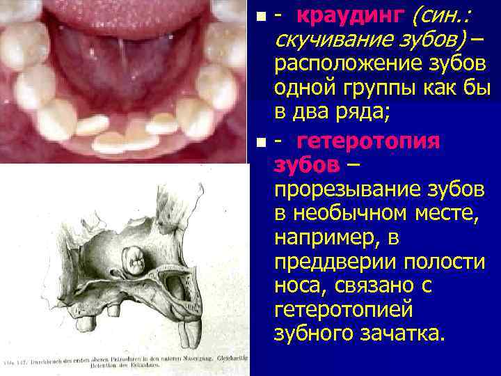 - краудинг (син. : скучивание зубов) – расположение зубов одной группы как бы в
