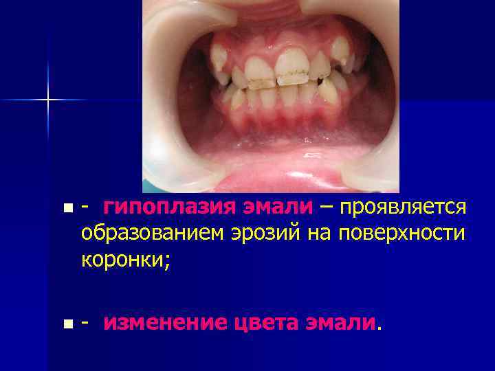n - гипоплазия эмали – проявляется образованием эрозий на поверхности коронки; n - изменение