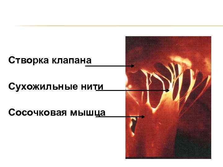 Створка клапана Сухожильные нити Сосочковая мышца 