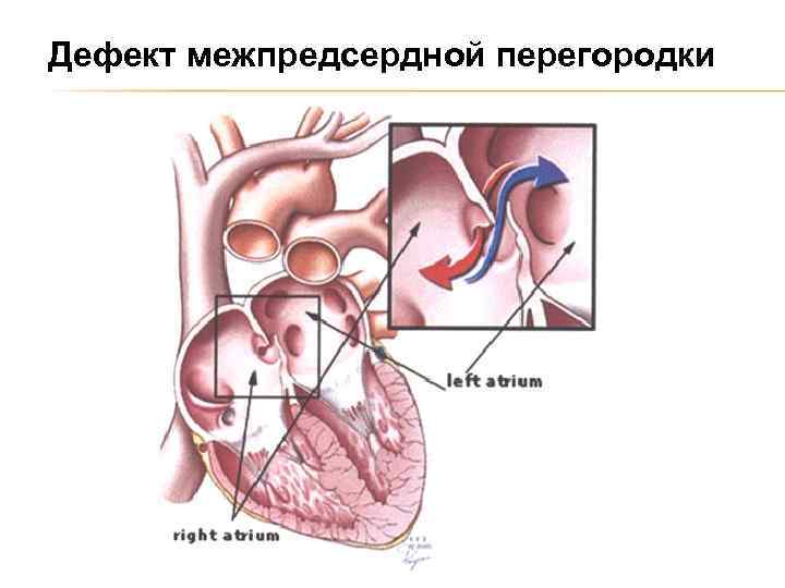 Для аускультативной картины дмпп характерно