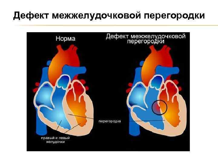 Дефект межжелудочковой перегородки 