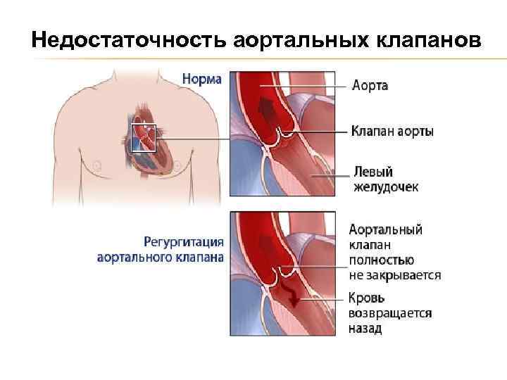 Недостаточность аортальных клапанов 