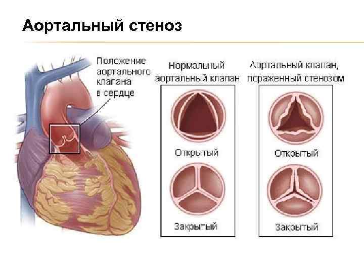 Аортальный стеноз 