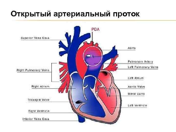 Открытый артериальный проток 