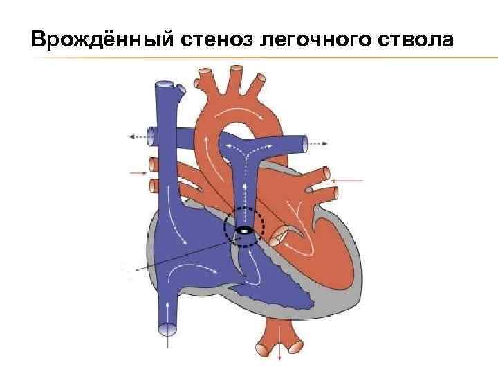 Стеноз легочной артерии. Стеноз клапана легочного ствола. Изолированный стеноз легочной артерии гемодинамика. Стеноз устья легочного ствола. Стеноз устья легочной артерии.