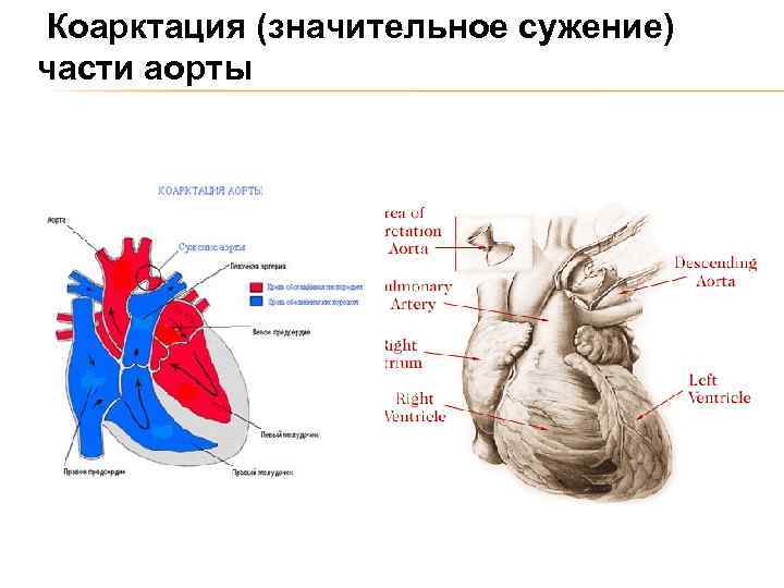 Коарктация (значительное сужение) части аорты 