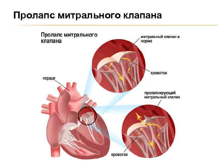 Пролапс митрального клапана 