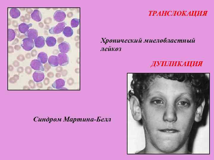 ТРАНСЛОКАЦИЯ Хронический миелобластный лейкоз ДУПЛИКАЦИЯ Синдром Мартина-Белл 