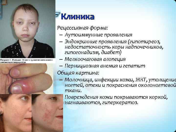 Клиника • Рецессивная форма: – Аутоиммунные проявления – Эндокринные проявления (гипотиреоз, недостаточность коры надпочечников,